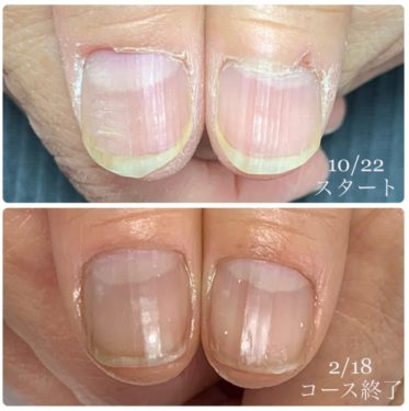 03-5　　ささくれ・皮膚あれ　育成前・結果